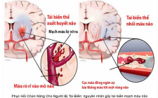Hỗ trợ điều trị tai biến mạch máu não và di chứng bằng Đông y