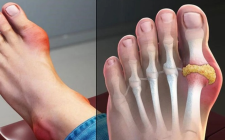Trị gout bằng y học cổ truyền như thế nào?