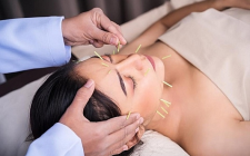 Châm cứu trị viêm xoang