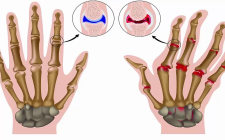 Đông y điều trị viêm khớp dạng thấp