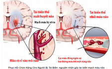 4 bài thuốc tốt cho người phục hồi sau đột quỵ nhồi máu não