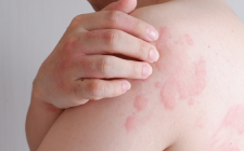 Điều trị nổi mề đay, mẩn ngứa bằng y học cổ truyền