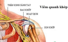 Điều trị viêm quanh khớp vai theo y học cổ truyền