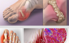  Trị gout bằng y học cổ truyền