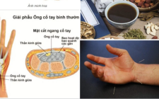  Y Học Cổ Truyền Điều trị hội chứng ống cổ tay 