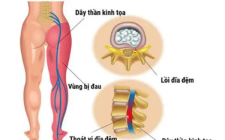 Điều trị  Đau thần kinh tọa (Yêu cước thống) theo y học cổ truyền