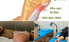 Đau ở gót chân