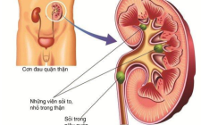 Đông y trị bệnh sỏi tiết niệu