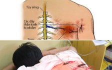  Đông y điều trị đau thần kinh sau  Zona