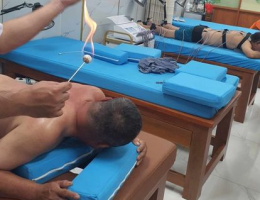 giác hơi bằng lửa