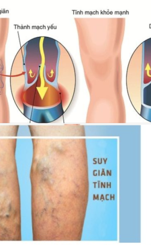 Đ&ocirc;ng y chữa suy gi&atilde;n tĩnh mạch ch&acirc;n