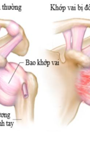 Vi&ecirc;m Quanh Khớp Vai - Triệu Chứng V&agrave; Thuốc Chữa Hiệu Quả