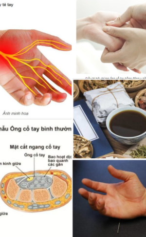 Điều trị hội chứng ống cổ tay bằng Y Học Cổ Truyền