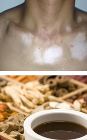 C&aacute;ch chữa bạch biến bằng Đ&ocirc;ng y an to&agrave;n, hiệu quả