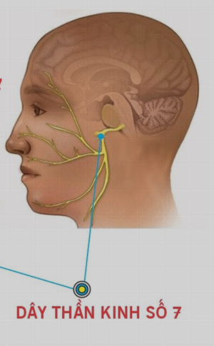 Bệnh l&yacute; về liệt d&acirc;y thần kinh số 7