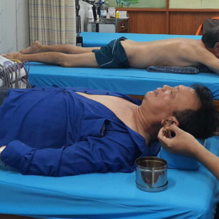 Điều trị di chứng sau liệt dây tk số VII- hào châm và cứu ngải