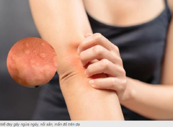Bài thuốc nổi mề đay, mẩn ngứa bằng y học cổ truyền