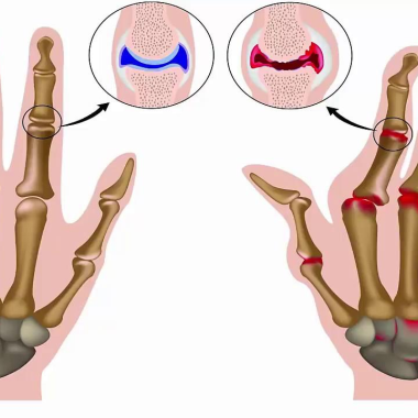 Đ&ocirc;ng y điều trị vi&ecirc;m khớp dạng thấp