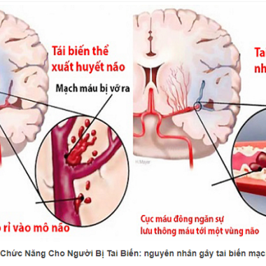 4 b&agrave;i thuốc tốt cho người phục hồi sau đột quỵ nhồi m&aacute;u n&atilde;o