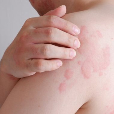 Điều trị nổi mề đay, mẩn ngứa bằng y học cổ truyền