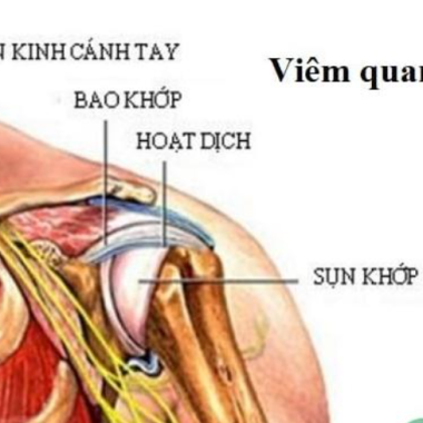 Điều trị vi&ecirc;m quanh khớp vai theo y học cổ truyền