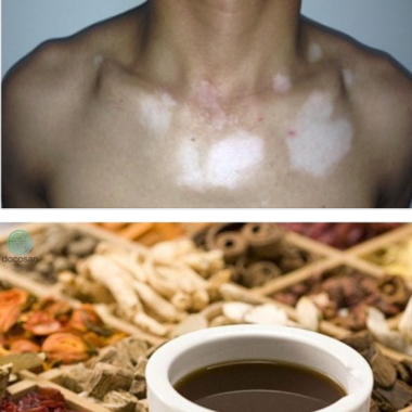 C&aacute;ch chữa bạch biến bằng Đ&ocirc;ng y an to&agrave;n, hiệu quả