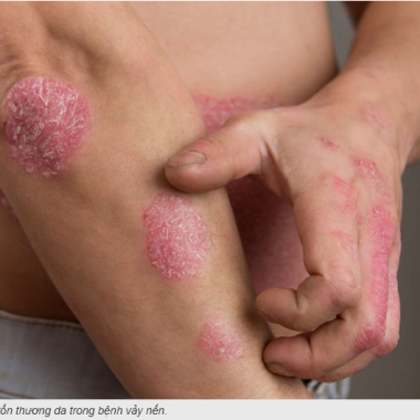 Trị bệnh vẩy nến bằng Đ&ocirc;ng y