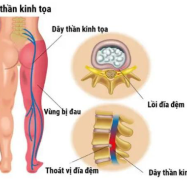 Điều trị  Đau thần kinh tọa (Y&ecirc;u cước thống) theo y học cổ truyền
