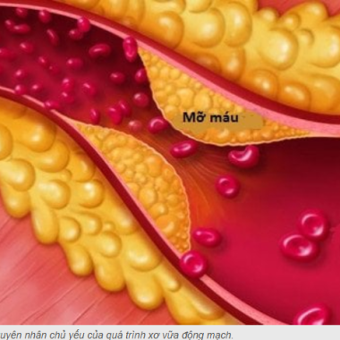 Đ&ocirc;ng y hỗ trợ điều trị rối loạn mỡ m&aacute;u