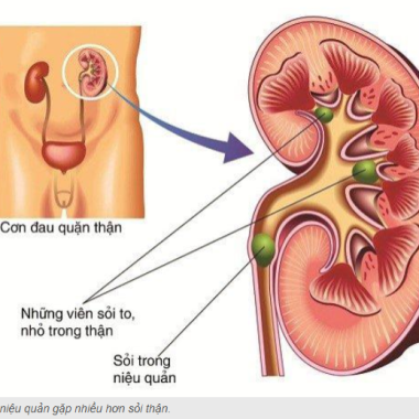 Đ&ocirc;ng y trị bệnh sỏi tiết niệu