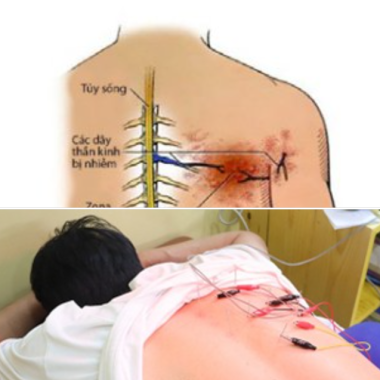  Đ&ocirc;ng y điều trị đau thần kinh sau  Zona