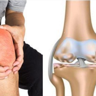 Điều trị tho&aacute;i h&oacute;a khớp gối bằng Đ&ocirc;ng y