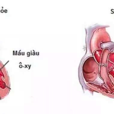Y học cổ truyền Điều trị suy tim