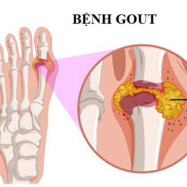 Trị Gout Tại T&acirc;n B&igrave;nh: Địa Chỉ Uy T&iacute;n Gi&uacute;p Bạn Sống Khỏe Mỗi Ng&agrave;y