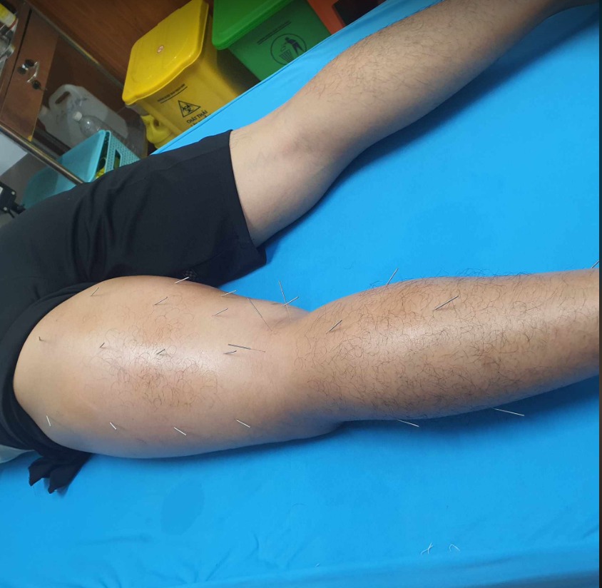 Điều trị suy giãn tĩnh mạch chân