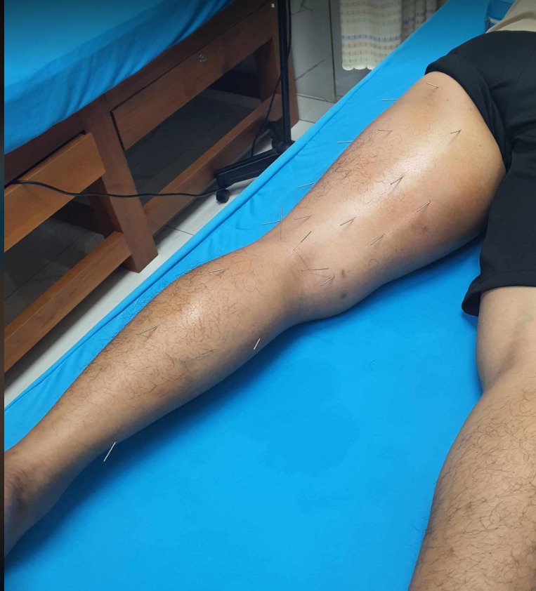 Điều trị suy giãn tĩnh mạch chân