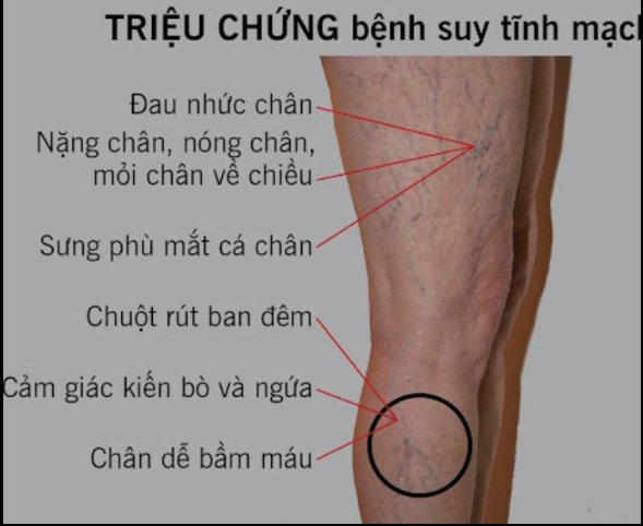 Điều trị suy giãn tĩnh mạch chân