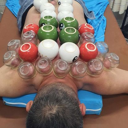 Điều trị đau bả vai bằng châm cứu - xoa bóp bấm huyệt - giác hơi tại PK YHCT Thuận Nhân. Ca bệnh này đã hết đau ngay sau liệu trình đầu tiên. Đau vai gáy là tình trạng cơ vùng vai gáy co cứng gây đau, kèm theo các hạn chế vận động khi quay cổ hoặc quay đầu.