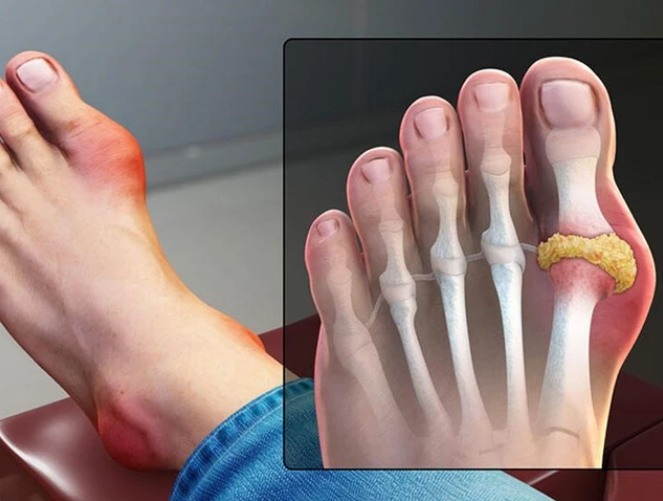 Trị gout bằng y học cổ truyền như thế nào?