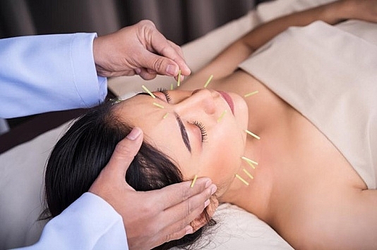 Châm cứu trị viêm xoang