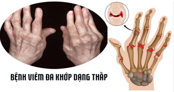 Đông y điều trị viêm khớp dạng thấp